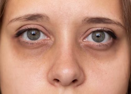 Conquering Dry Eye: Expert Tips and Insights for Optimal Eye Care